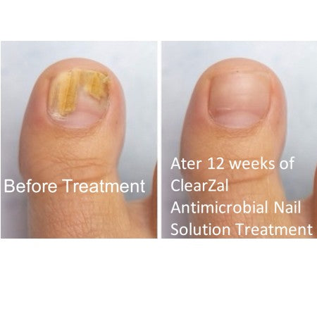 ClearZal - COMPLETE FOOT & NAIL SYSTEM